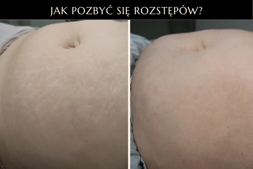 Jak zadbać o brzuch po porodzie i skutecznie walczyć z rozstępami?