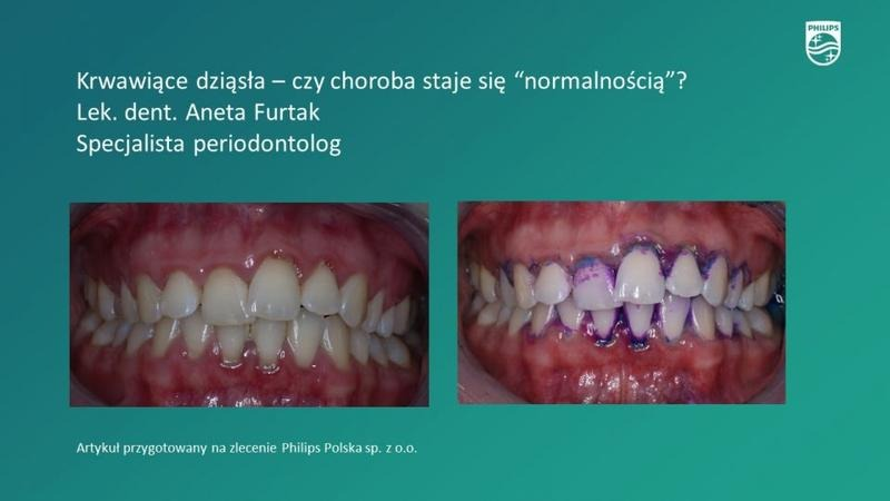 Jaka pasta na krwawiące dziąsła podczas ciąży? Bezpieczny skład i praktyczne wskazówki