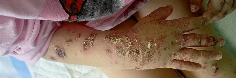 Ospa w przedszkolu – co robić? Przewodnik po kluczowych krokach dla rodziców