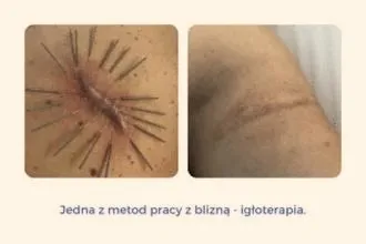Rana po porodzie piecze – co jest normalne i kiedy iść do lekarza