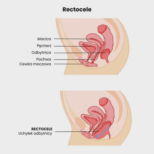 Rectocele po porodzie: jak rozpoznać objawy i skutecznie je leczyć?