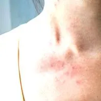 Alergia na banany