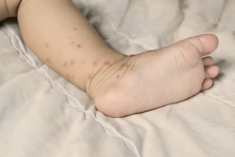 Alergia na gluten