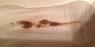 Objawy infekcji