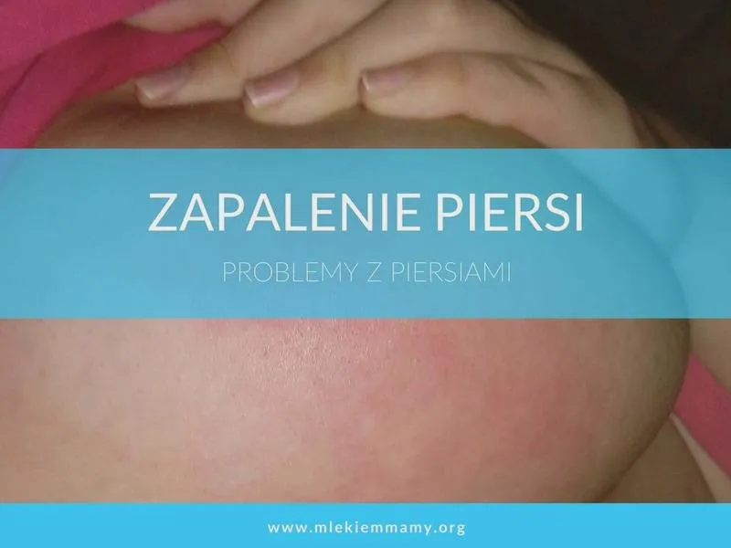 Objawy zapalenia piersi