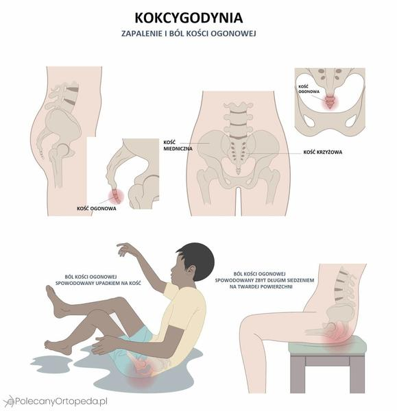 Uraz kości ogonowej