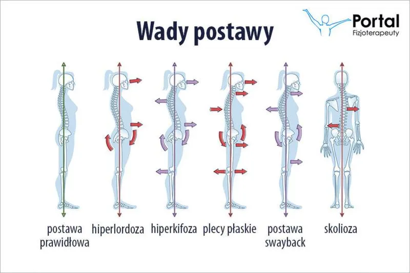 Wady postawy u dzieci